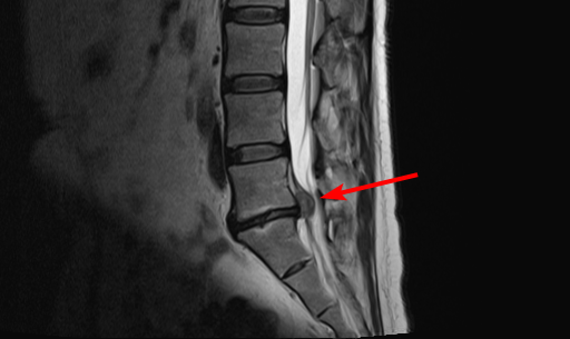 A white on black medical MRI image: the lower 3 lumbar and top 3 sacral vertebrae. The disc between the lumbar and sacral vertebrae is compacted compared to those above, and a red arrow indicates the fluid ballooned out from the back of the herniated disc.